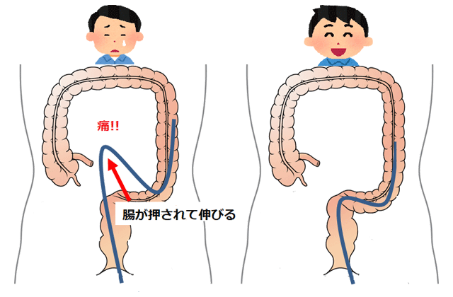 胃カメラと大腸カメラの違いのイメージ