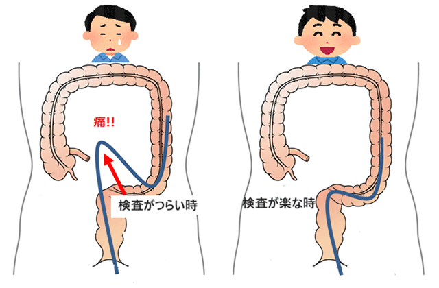 大腸内視鏡（大腸カメラ）のイメージ