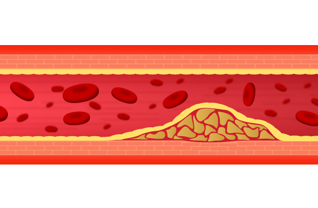 高尿酸血症のイメージ